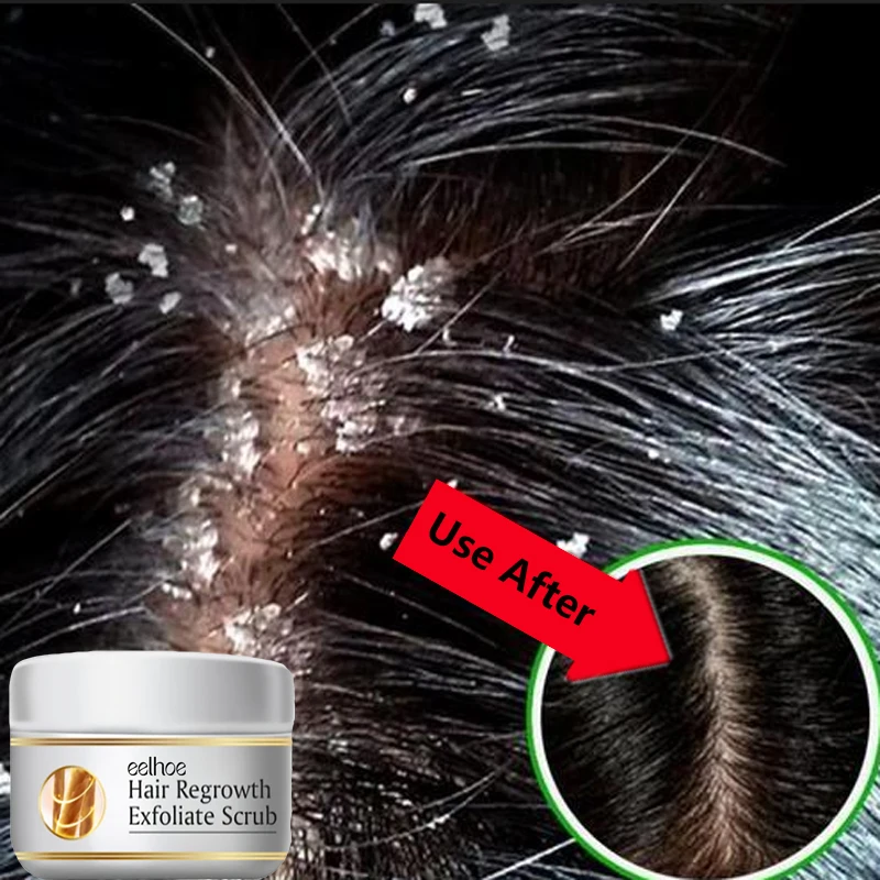 Scalp Scrub Exfoliant - สครับขจัดรังแคสูตรเร่งด่วน บรรเทาอาการคัน ทำความสะอาดหนังศีรษะ ผลิตภัณฑ์ขัดผิว ควบคุมความมัน ป้องกันอาการคัน