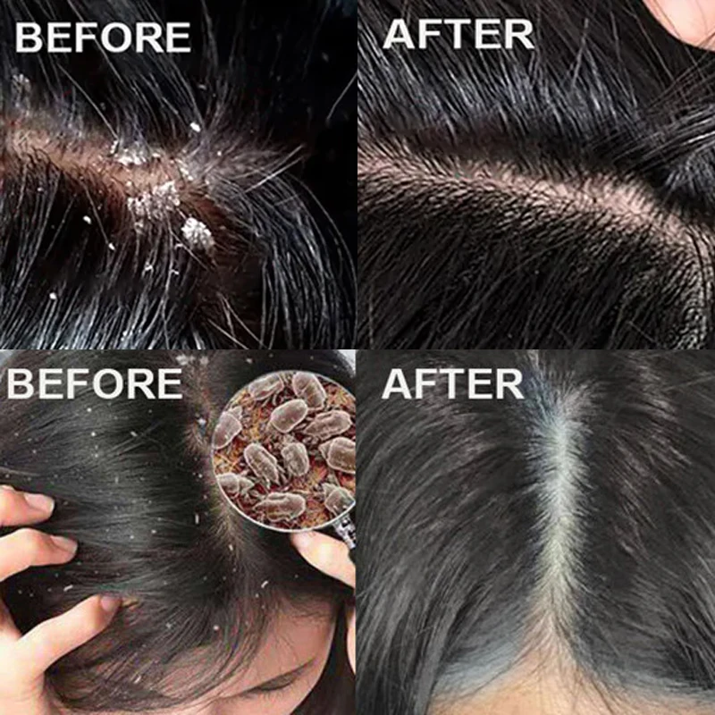 สครับขจัดรังแคสูตรเร่งด่วน บรร - Scalp Scrub Exfoliant บทวิจารณ์และราคา