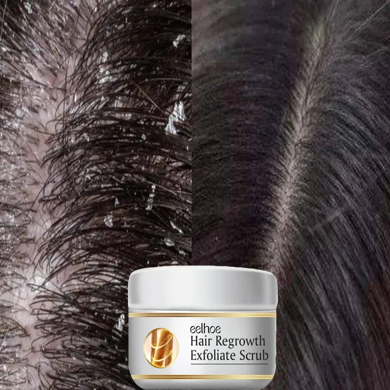สครับขจัดรังแคสูตรเร่งด่วน บรร - Scalp Scrub Exfoliant บทวิจารณ์และราคา