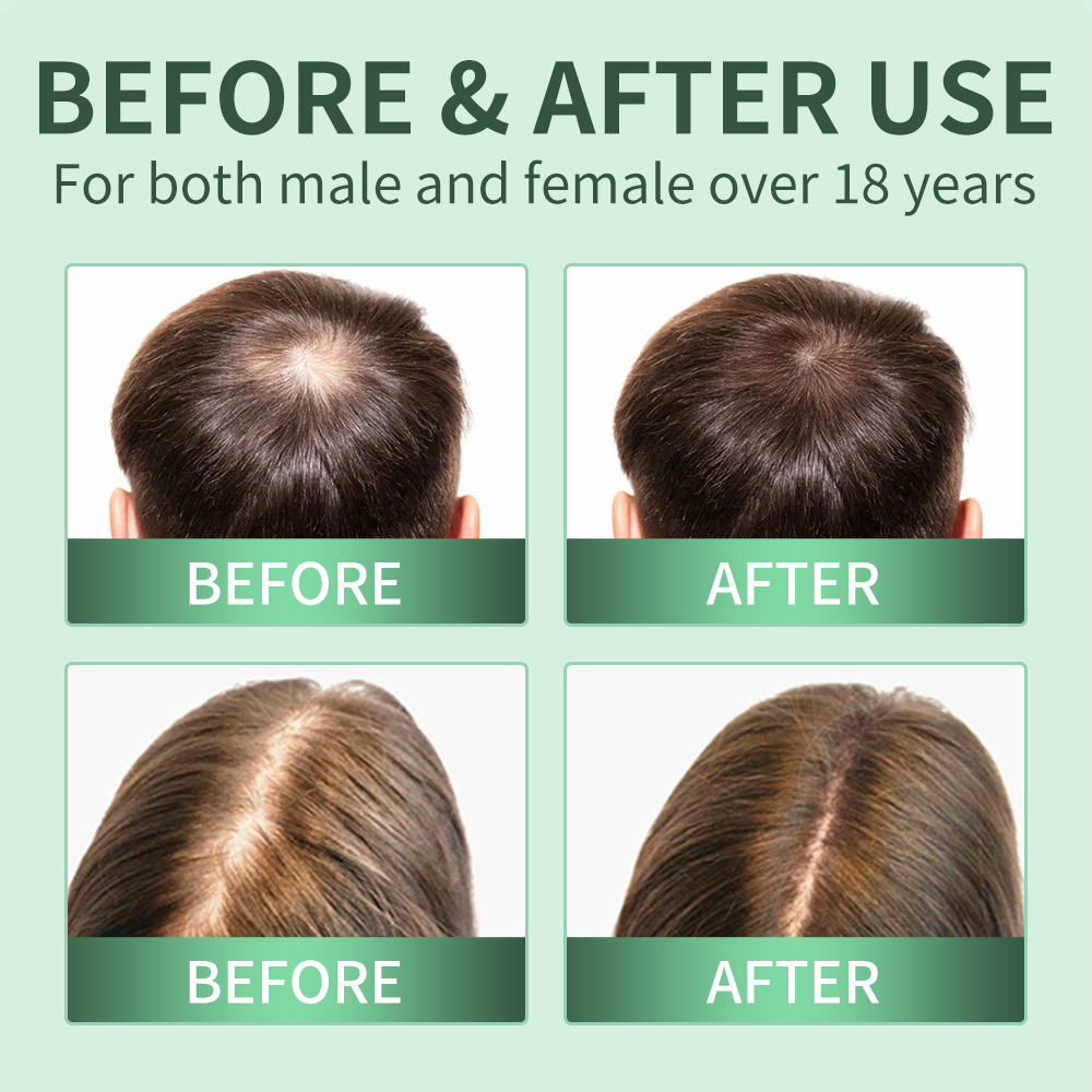 สเปรย์ปลูกผม, สครับหนังศีรษะ,  - Scalp Scrub Exfoliant บทวิจารณ์และราคา